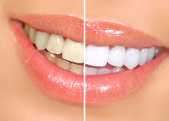 عکس تبلیغاتی دندانپزشکی و روکش سرامیکی