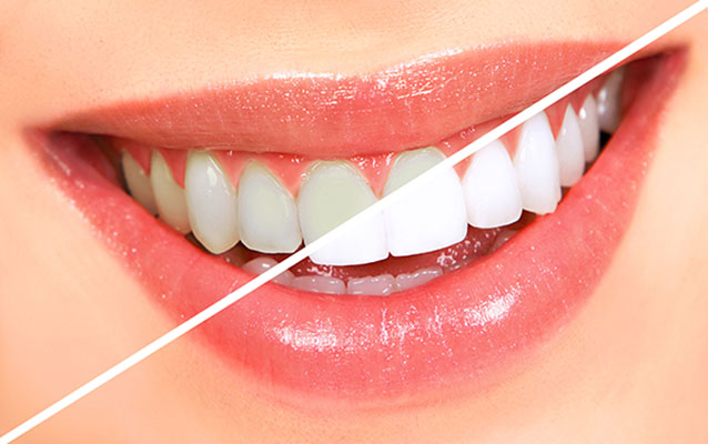 عکس تبلیغاتی دندان پزشکی و لمینت