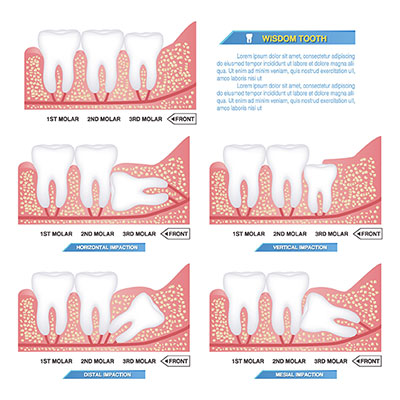 وکتور دندانپزشکی و دندان عقل